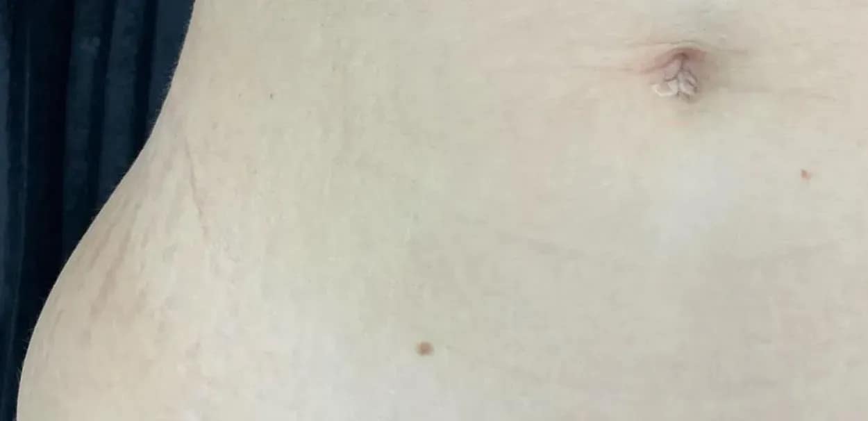 Skóra przed i po zabiegu na rozstępy (przed i po)